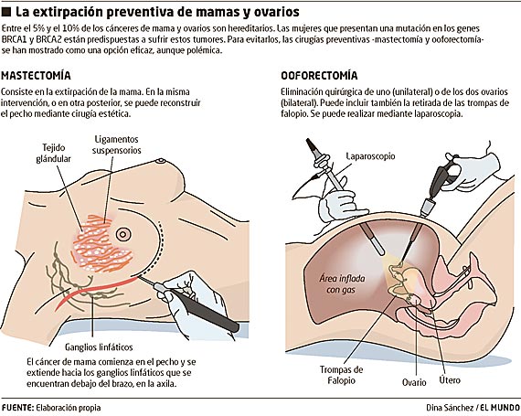 ooforectomia-extirpacion-ovario